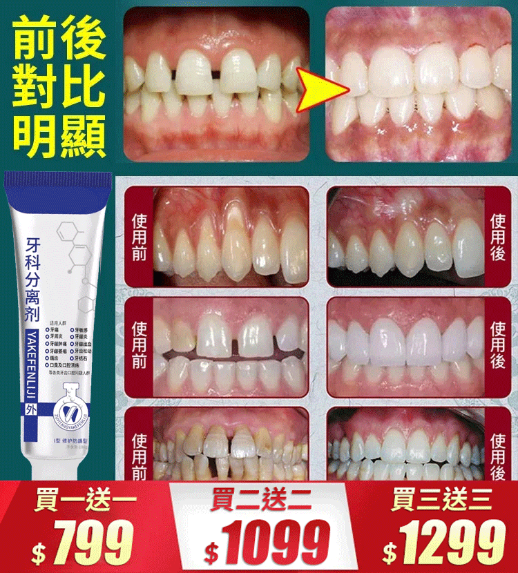 【改善牙齦腫痛、敏感、出血、牙齒鬆動問題】牙齒分離劑牙膏