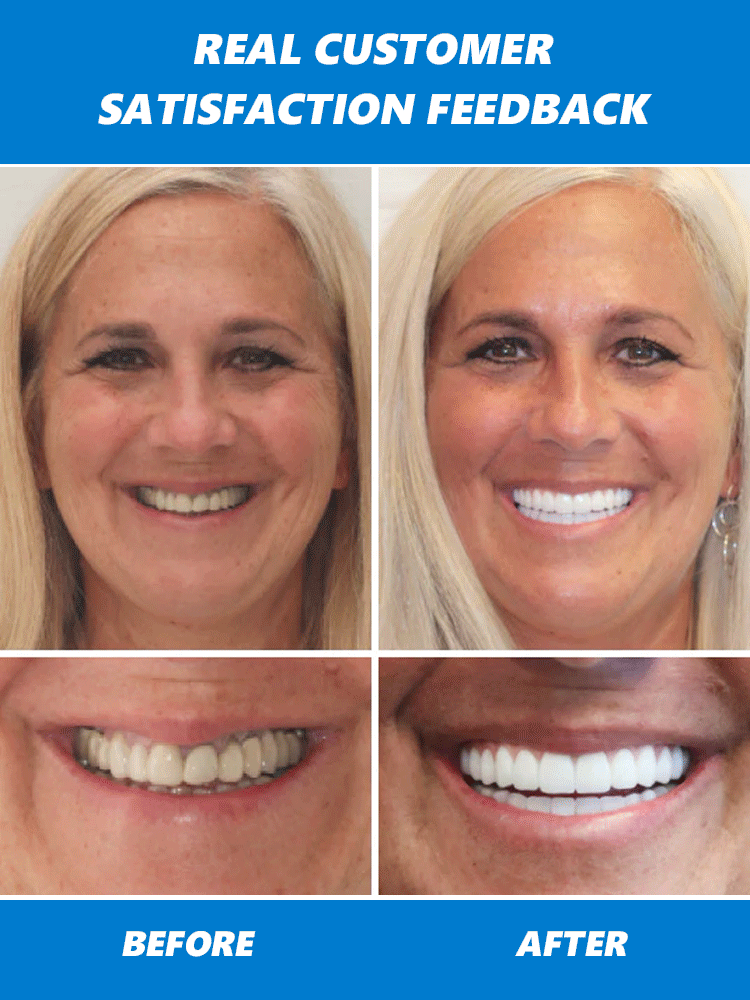 【 Dual Certification】Self-Molding Denture Kit