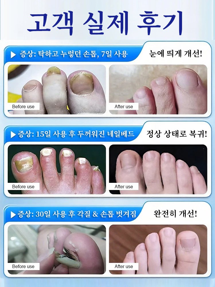 무좀 손톱 치료 에센스