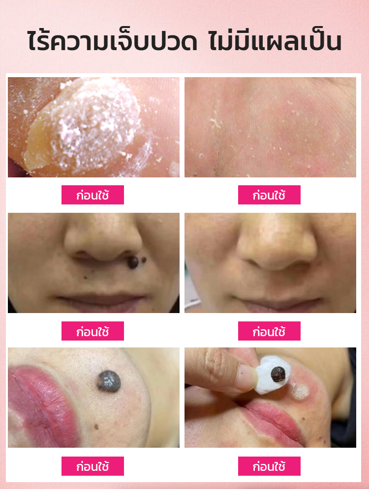 ครีมกำจัดไฝและหูดที่ดื้อรั้น