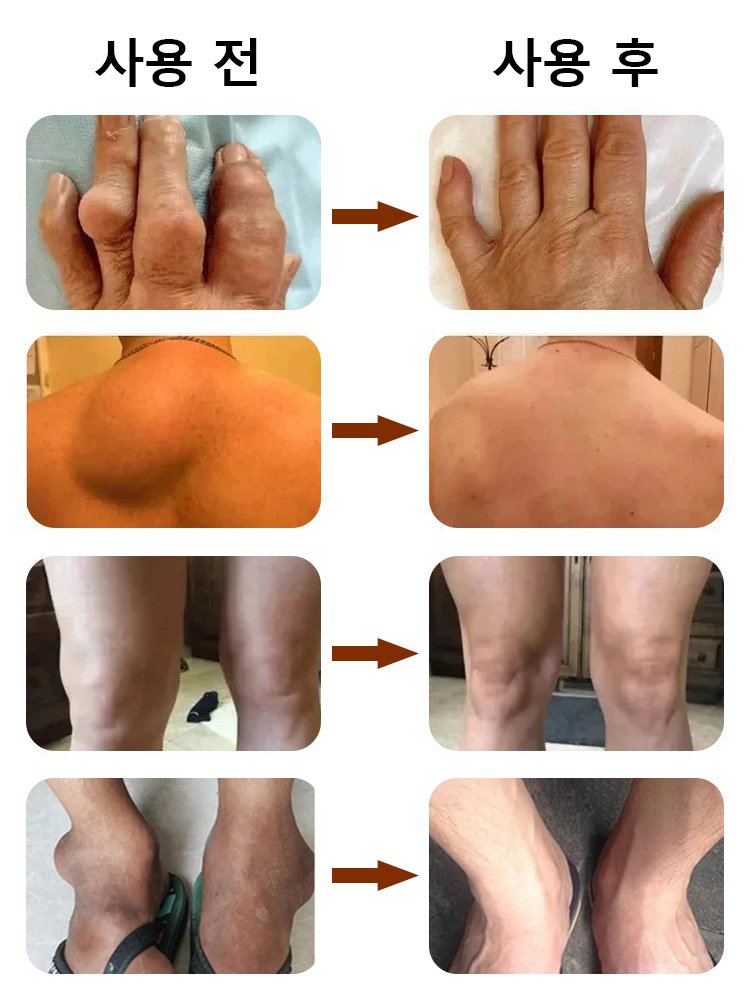 【전문적인 산성 마비 통증 치료】허브 관절 복원 패치