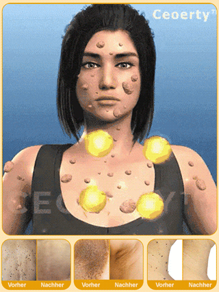 Körperpflege Warzenentfernungslösung