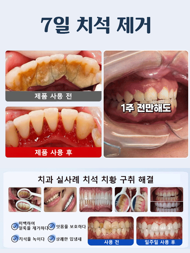 【한 번 닦으면 하얗게】의료용 등급 구강 보호 치약