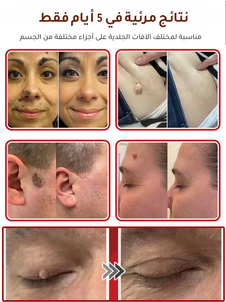 لصقات العناية بالبشرة لإزالة الثآليل من الوجه والجسم