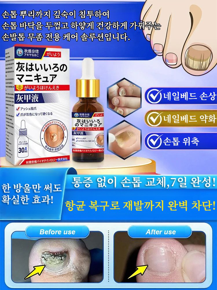 무좀 손톱 치료 에센스