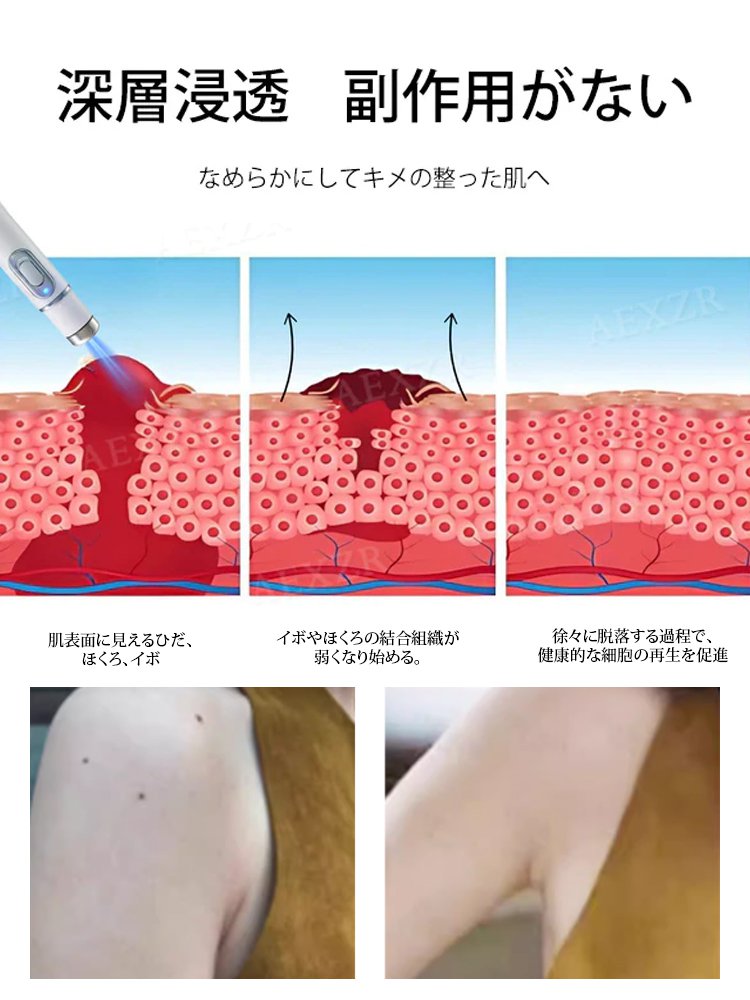 レーザーイボ取り美顔ペン