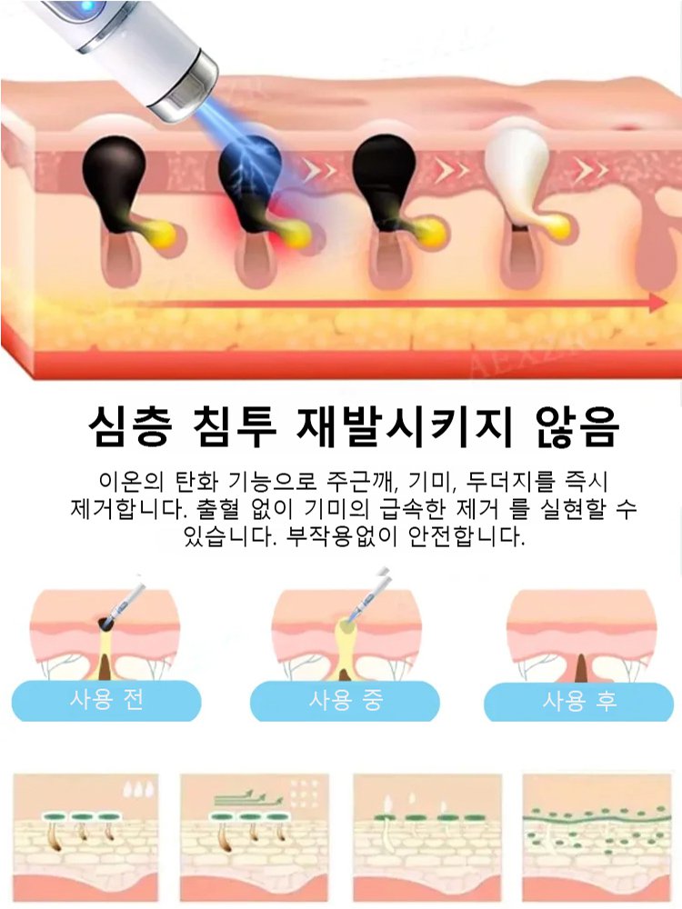 레이저 무통 사마귀 제거 펜
