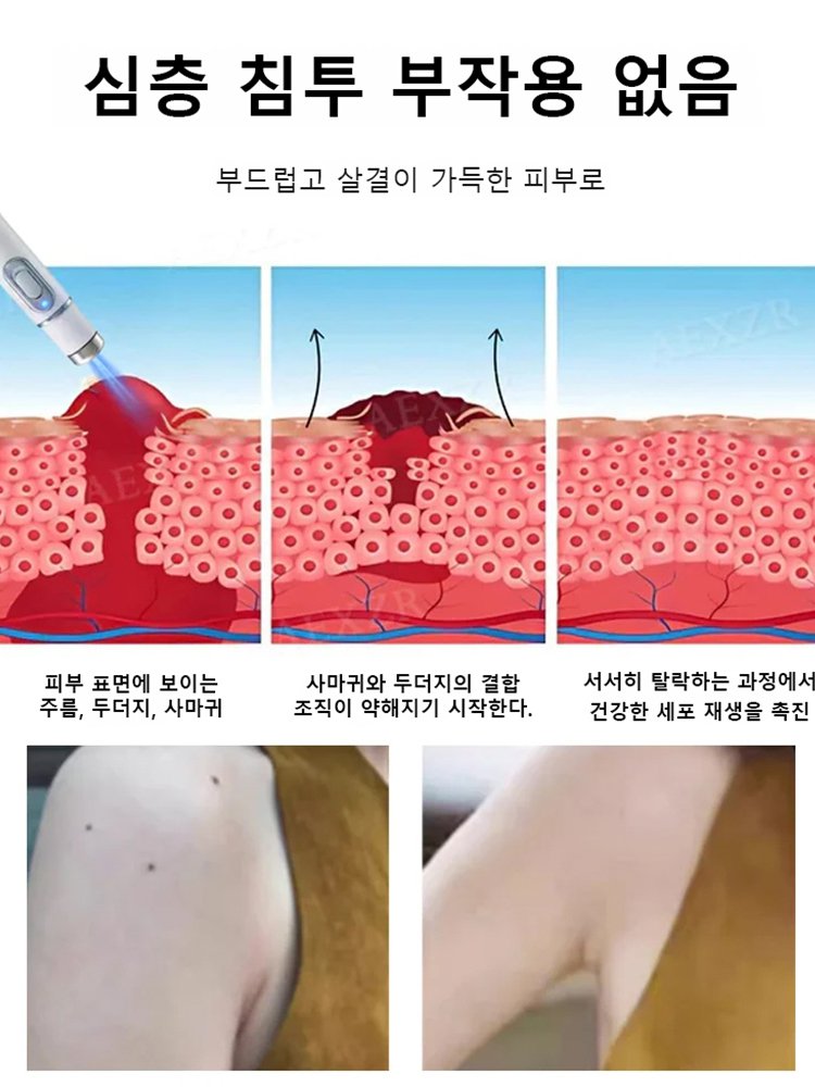 레이저 무통 사마귀 제거 펜