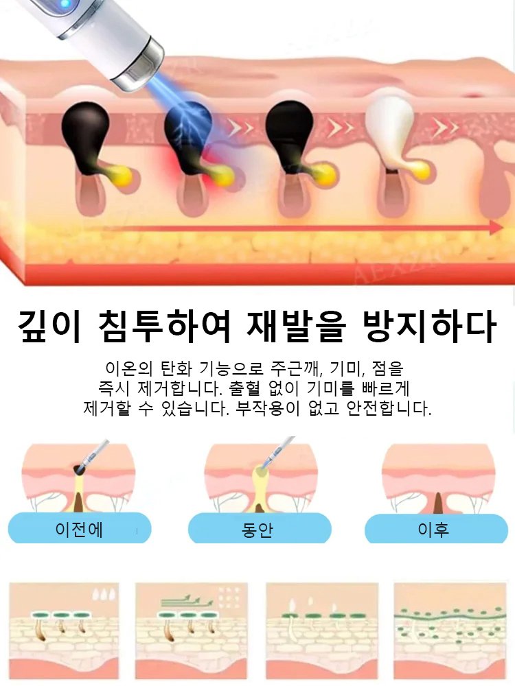 레이저 무통 사마귀 제거 펜