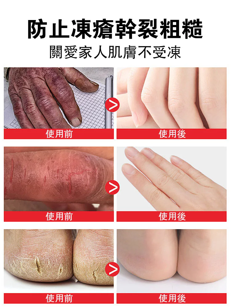 【擺脫手腳乾裂】黃耆裂可寧