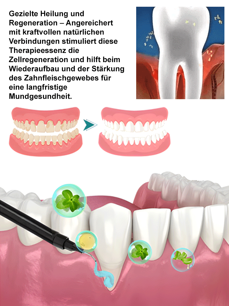 Oralhoe Zahnfleischschutzmittel
