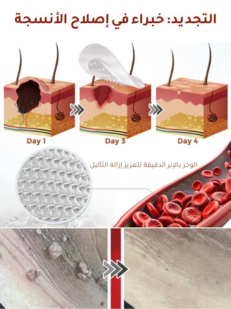 لصقات العناية بالبشرة لإزالة الثآليل من الوجه والجسم