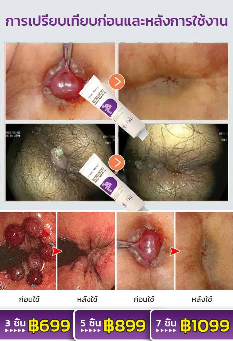 【ผลิตภัณฑ์ใหม่】ครีมรักษาริดสีดวงทวารภายใน ภายนอกและแบบผสม