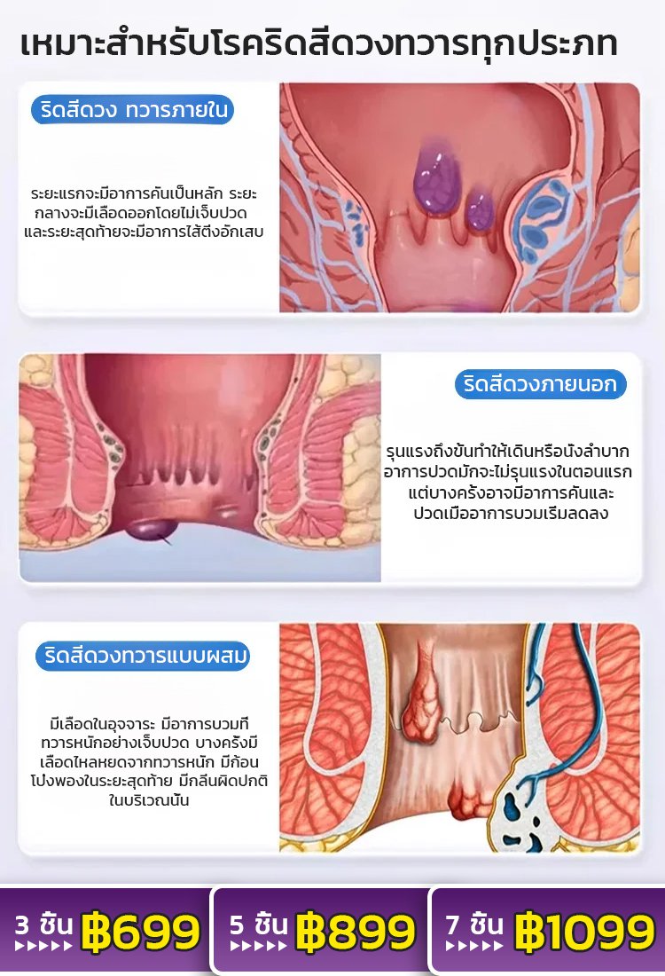【ผลิตภัณฑ์ใหม่】ครีมรักษาริดสีดวงทวารภายใน ภายนอกและแบบผสม