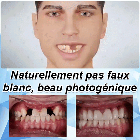 Prothèse dentaire ensemble de beauté dentaire