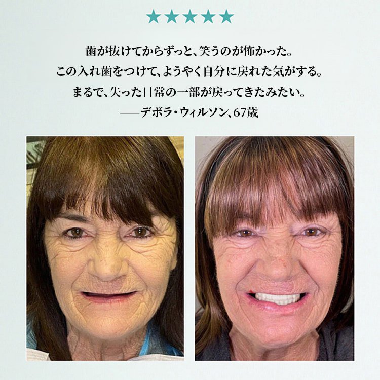 【3イン1】入れ歯セット、7日間無料試着。