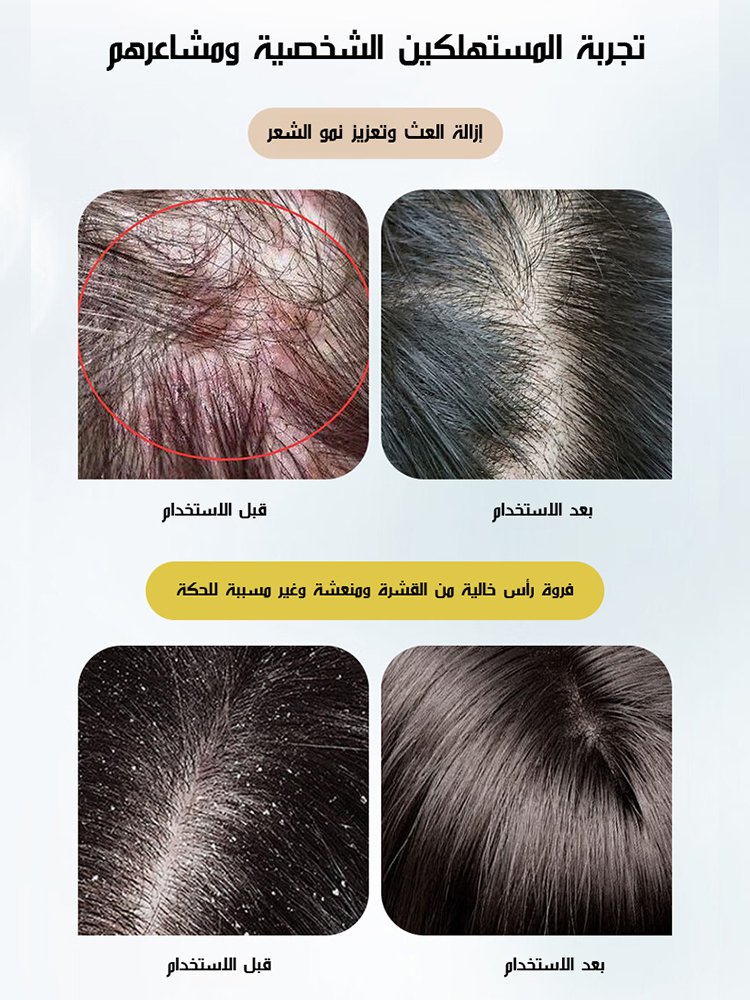 شامبو إكليل الجبل والأحماض الأمينية لمنع تساقط الشعر (فعّال في منع التساقط)