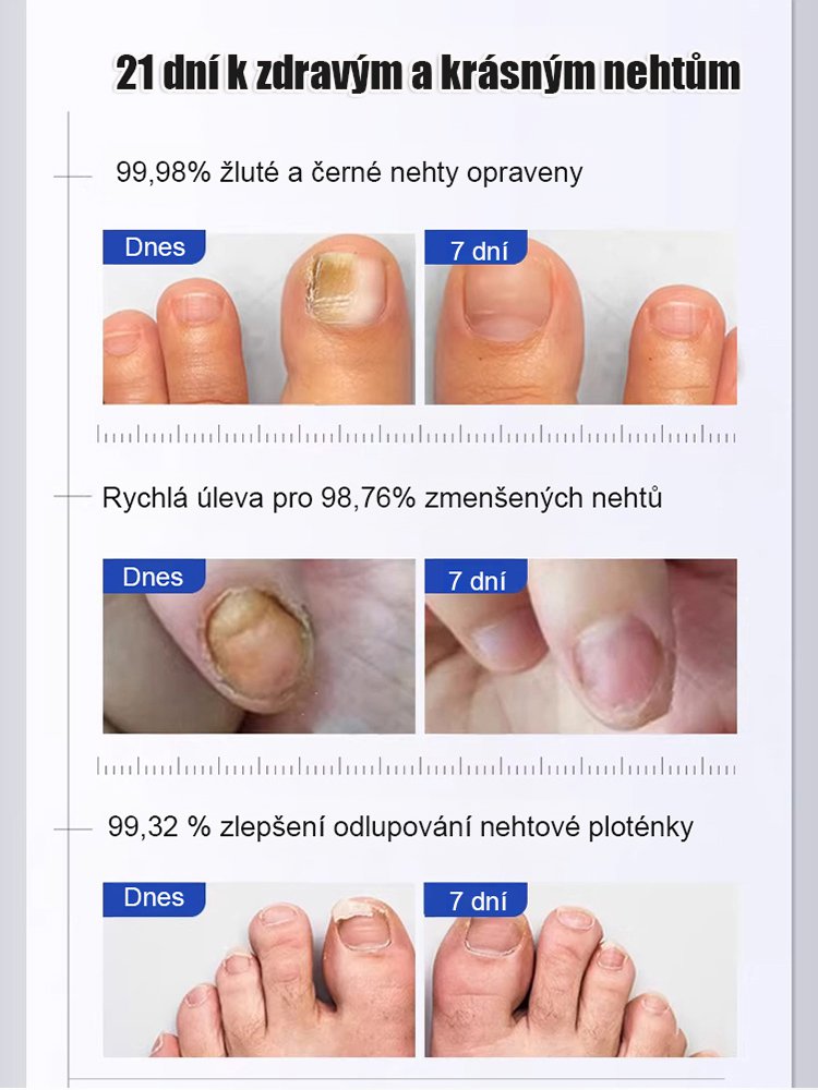 Silná antimykotická tužka na opravu nehtů