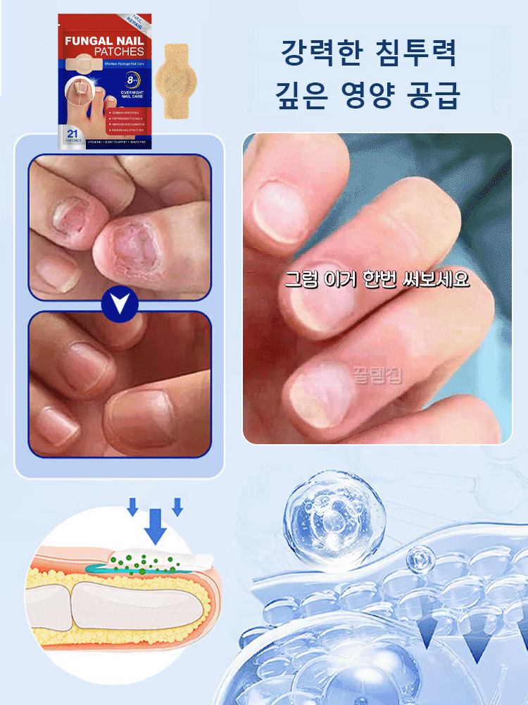 손톱 케어 교정 항균 패치