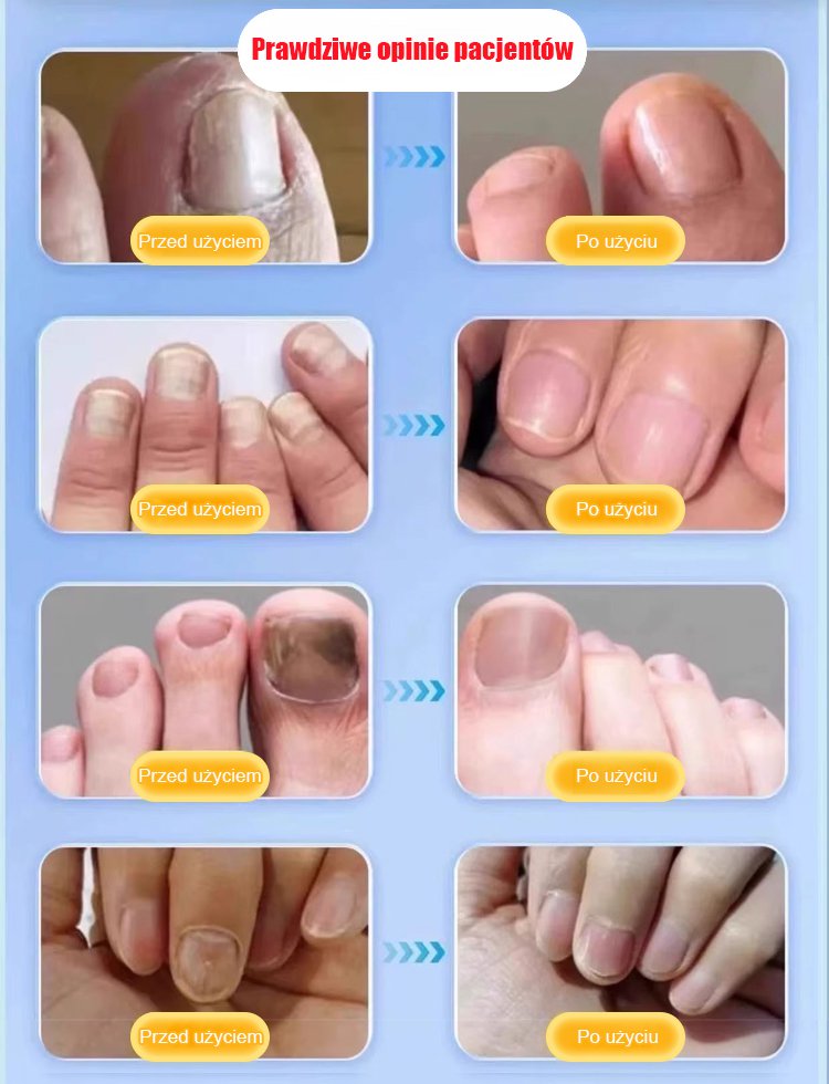 [Rozwiązanie problemu z paznokciami] Antybakteryjny krem naprawczy na grzybicę paznokci
