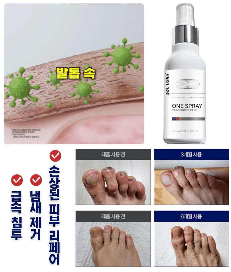 발 진균 관리 스프레이
