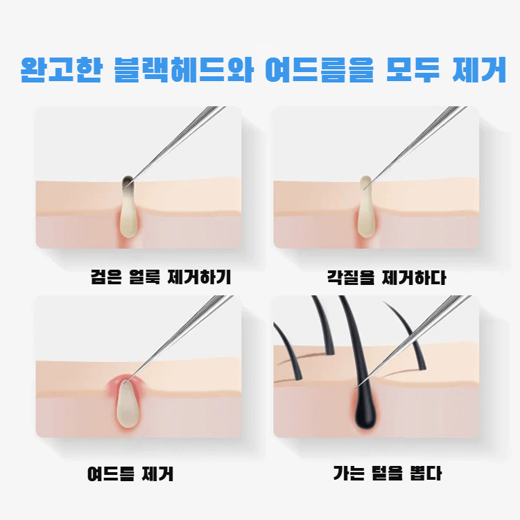【최고 국립대병원 피부과 전문의 추천, 1초 만에 완고한 블랙헤드와 여드름을 깨끗하게 제거】의료용 SUS420 스테인리스초정밀 블랙헤드 제거 3종 세트