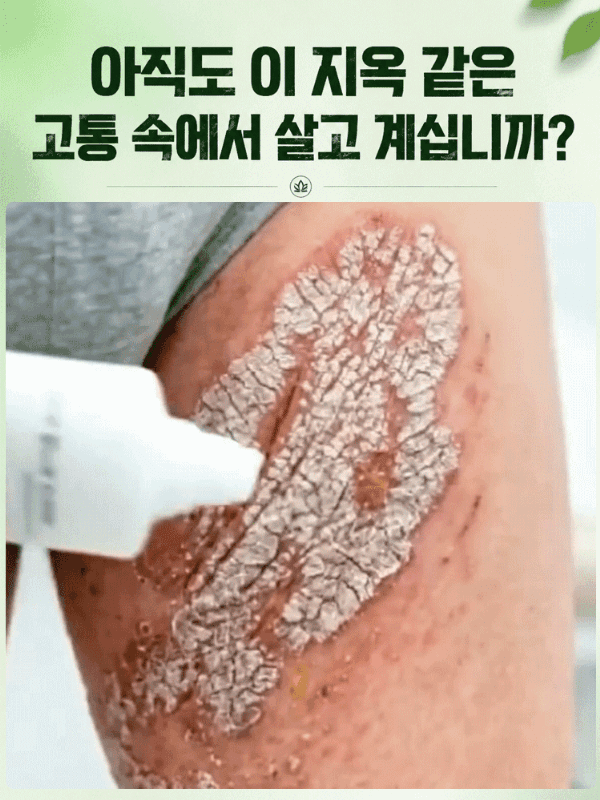 【피부염 집중 케어】피부 진정 케어 크림
