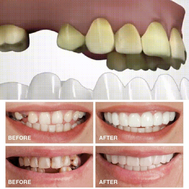 【デンタルマウスピース】簡単な一歩で素敵な笑顔を手にしましょう！フィット感抜群　目立たない　