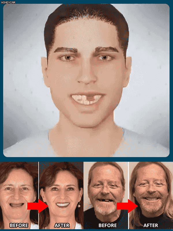 【アメリカ公式おすすめ】シリコン入れ歯