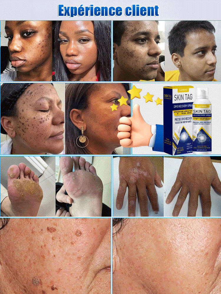 LANISKA spray de soin topique pour points de verrues