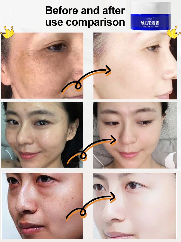 【Old Spots and Yellow Spots Disappear】Spot Fading Urea Cream