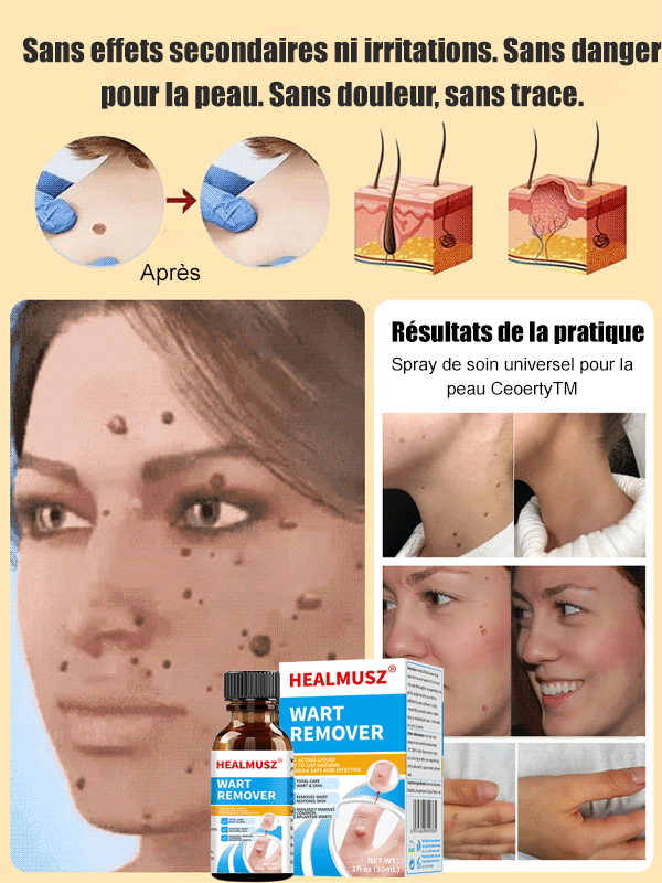 Solution pour éliminer les verrues corporelles