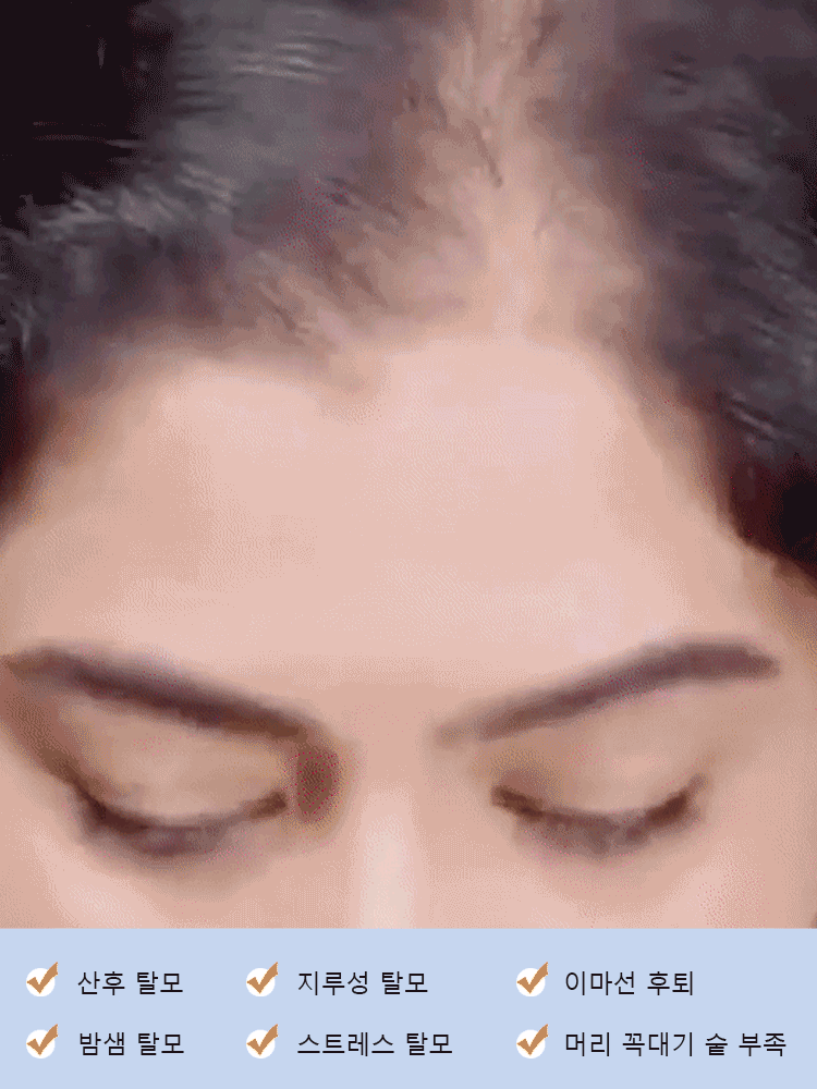 【인기 상품】X 탈모 혁신 앰플