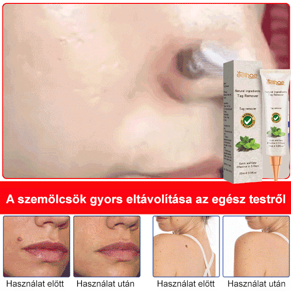 Eelhoe szemölcseltávolító kenőcs