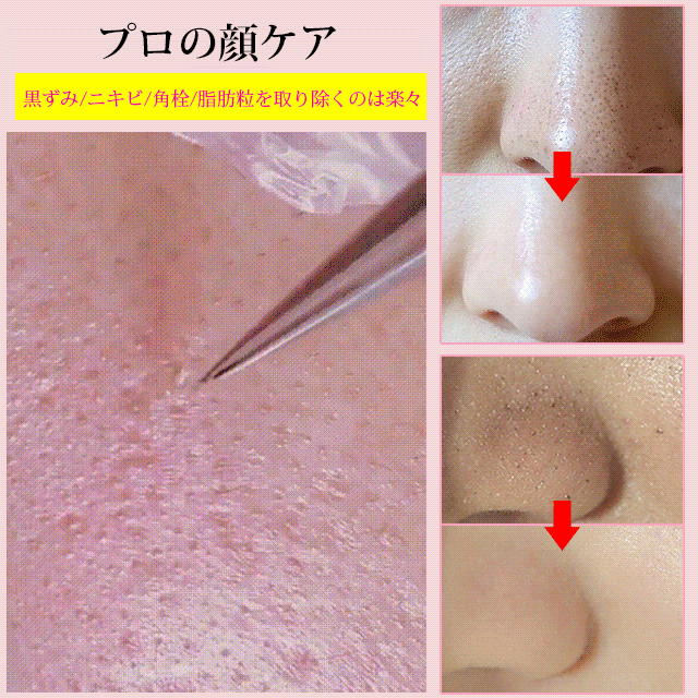 ステンレススチールコメドプッシャー