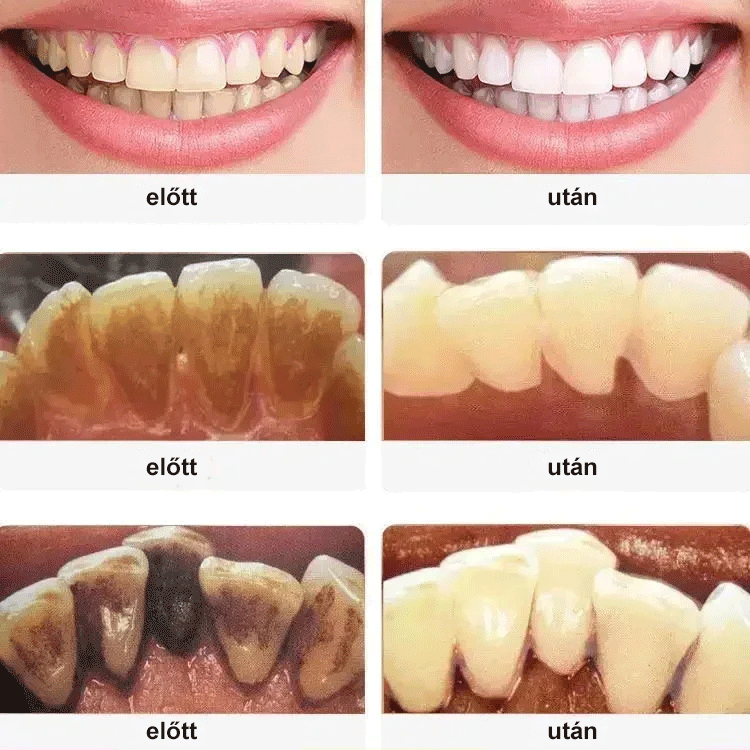 Hordozható elektromos fogkefe szájhigiéniai eszköz