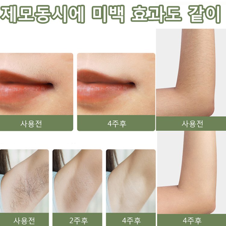 가정용 IPL제모기