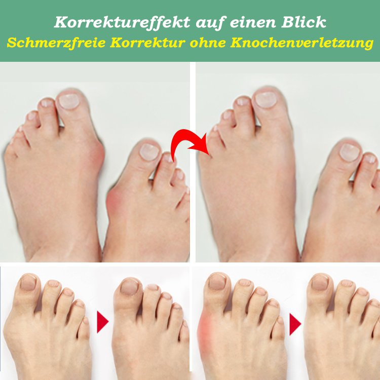 【Vom Arzt empfohlen】 Unisex-Bunion-Korrektor